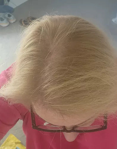 Visible before-and-after hair growth results using Calistara™ Red Light Therapy Cap