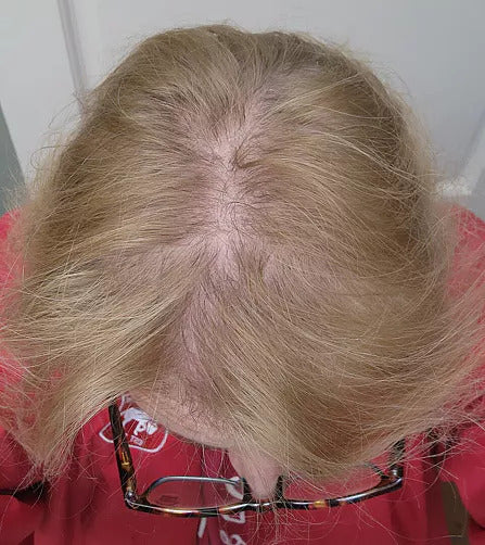 Before and after hair regrowth results from Calistara™ therapy